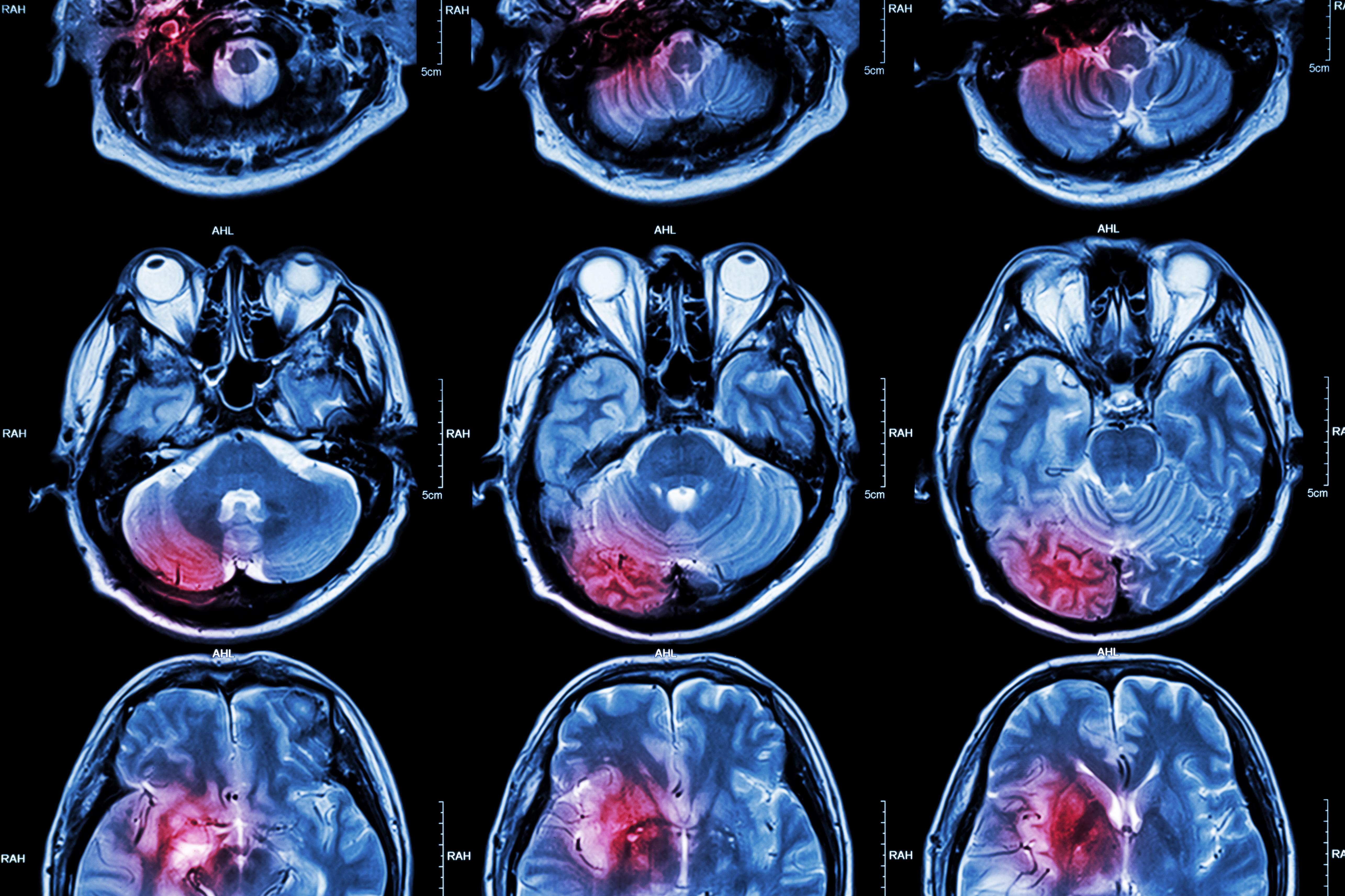 Head Injuries